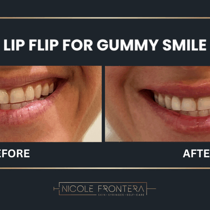 botox lip flip for gummy smile