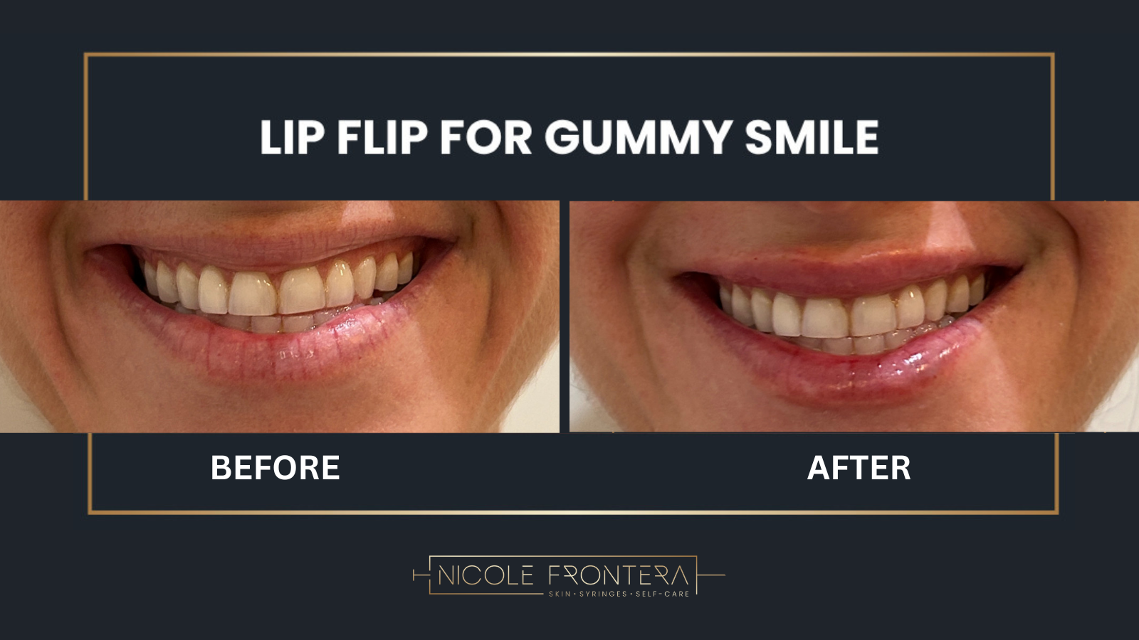 Is Your Gummy Smile Hiding Your Confidence? The Botox Lip Flip Can Help