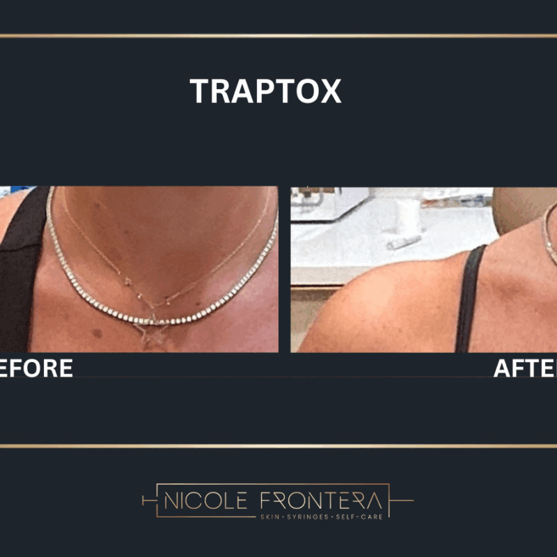 traptox before & after rockaway park queens ny - nfb