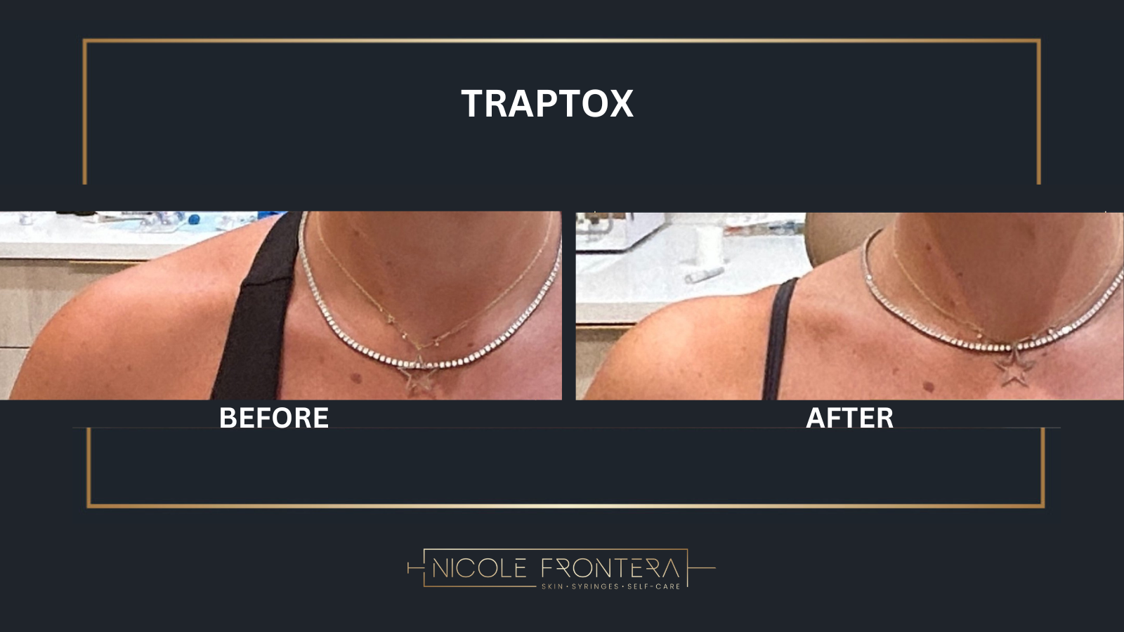 Can TrapTox Really Improve Your Posture and Relieve Pain?