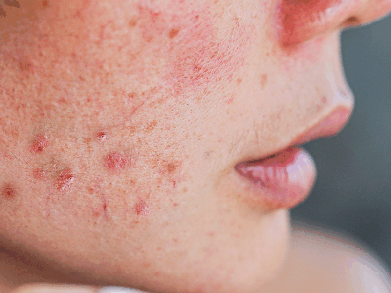 What to Expect During an IPL Photofacial