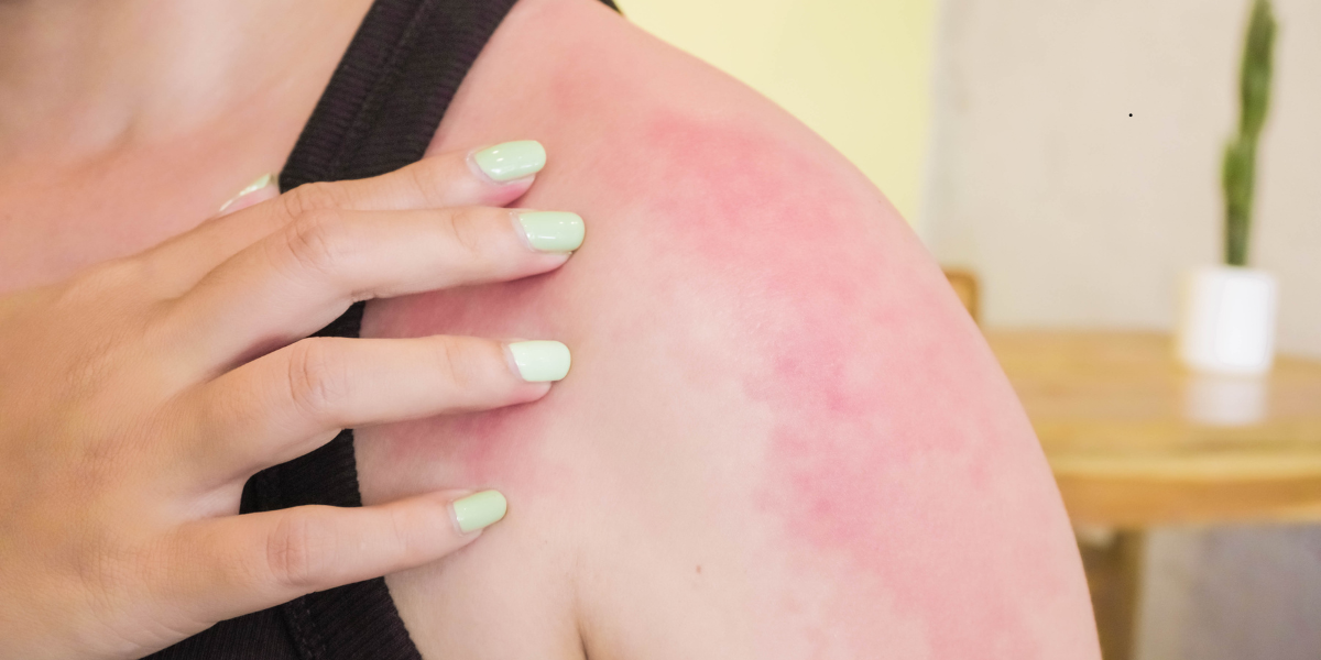 Who Is a Good Candidate for IPL for Redness