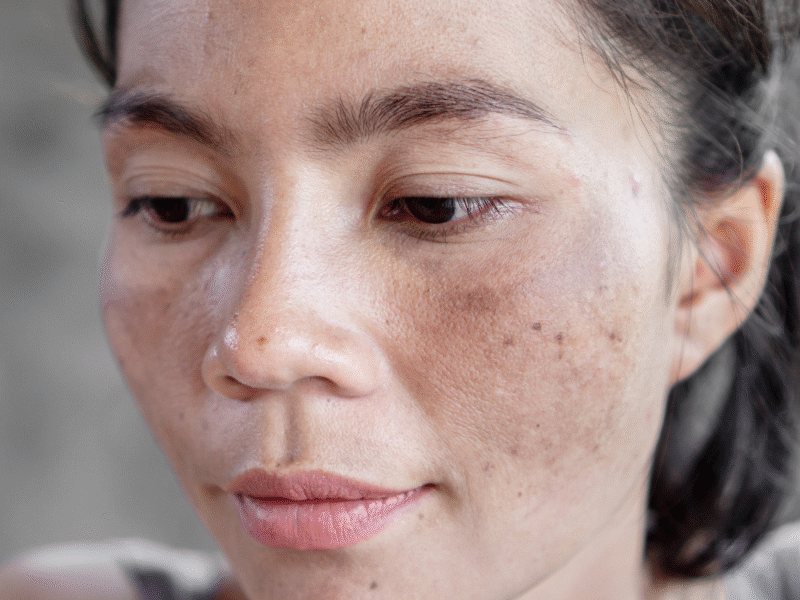 How to Get Rid of Brown Spots