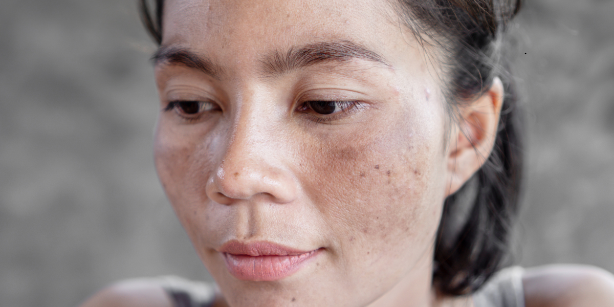 How to Get Rid of Brown Spots